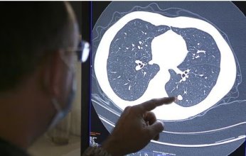 خاص| لماذا يعيش بعض المصابين بأنواع عدوانية من السرطان لفترات أطول من المتوقع؟ دراسة تكشف السبب