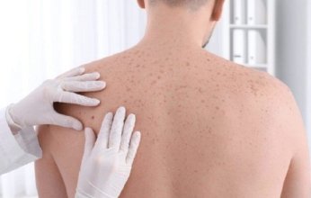 دراسة علمية حديثة تكشف آلية جديدة لفهم تطور سرطان الجلد الأكثر فتكاً