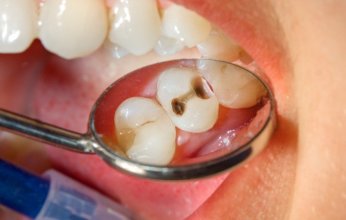 90% من سكان العالم يعانون منه.. تسوس الأسنان يؤدي لمشكلات صحية خطيرة للإنسان