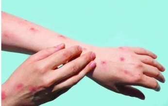 الولايات المتحدة الأمريكية تسجل أول حالة إصابة بجدري القردة