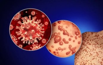 الأمر خرج عن السيطرة.. تحذيرات من استمرار تفشي "جدري القردة" في أفريقيا