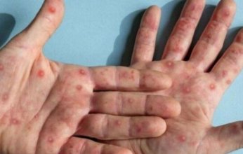 تقارير تكشف عن أول انتقال محلي لفيروس جدري القرود خارج أفريقيا.. ما القصة؟