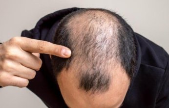 علماء يكتشفون "مفتاح سري" قد يكون الحل لتساقط الشعر