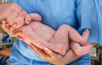 المغرب: ارتفاعًا مقلقًا في وفيات الحصبة و تحذيرات من الأطباء بسرعة التطعيم