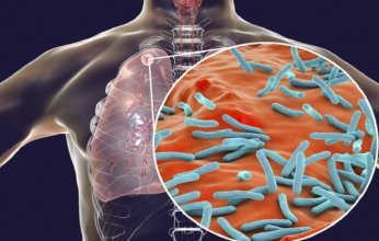 تفشٍ غير مسبوق لمرض السل في ولاية كانساس الأمريكية.. ماذا يحدث؟