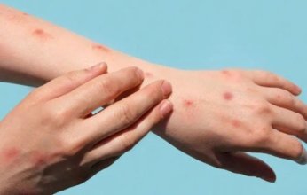 فرنسا تسجل أول إصابة بسلالة جديدة من "جدري القردة"