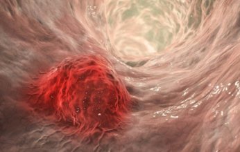 دراسة حديثة: الجسيمات البلاستيكية الدقيقة قد تكون سببًا للسرطانات غير المبررة