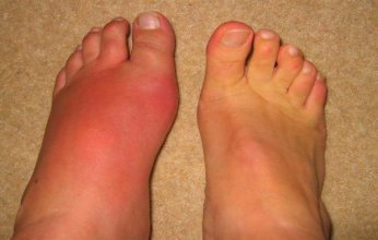 أطعمة تزيد من خطر الإصابة بالنقرس وتفاقم أعراضه