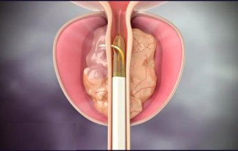 باحثون أمريكيون يطورون علاجا مبتكرا لسرطان البروستاتا دون جراحة