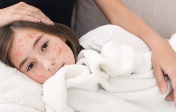 معظمهم من الأطفال والمراهقين.. ارتفاع عدد المصابين بـ«الحصبة» في تكساس لـ48 حالة.. ماذا يحدث؟