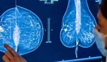 بريطانيا تطلق أكبر تجربة فى العالم لتشخيص سرطان الثدى بالذكاء الاصطناعى