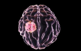 أطباء يحذرون من إمكانية تحول البقع الجلدية إلى ورم في الدماغ