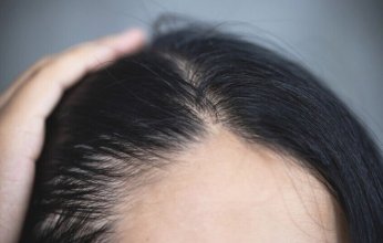 طبيبة تكشف عن مكون طبيعي يعالج مشكلات فروة الرأس