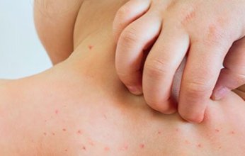 تفشى مرض الحصبة جنوب الولايات المتحدة الامريكية ووفاة 230 شخصا