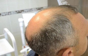 اكتشاف علمي جديد يمنح الأمل في محاربة الصلع.. ما التفاصيل؟