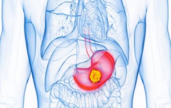 دراسة جديدة تكشف عن مراحل مبكرة وسبب محتمل جديد لسرطان المعدة