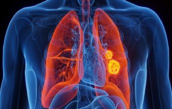 دراسة حديثة تكشف دور التغذية في سرطان الرئة.. "الغليكوجين.. وقود الأورام الخفي"