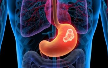 دراسة حديثة: الإفراط في تناول الملح يزيد خطر الإصابة بسرطان المعدة