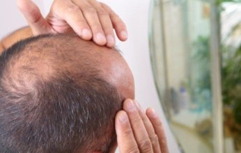 التوتر يسبب الصلع.. كيف يؤثر الإجهاد على صحة الشعر؟