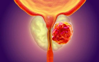 اختبار ثوري يحقق قفزة نوعية في تشخيص سرطان البروستات