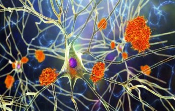 ثورة في علم الأعصاب.. تقنية مبتكرة في علاج ألزهايمر قد تكون بداية للقضاء عليه نهائيًا