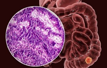 السبب الخفي وراء تفشي سرطان القولون بين الشباب: العلاقة مع بكتيريا الإشريكية القولونية