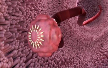 هل تعاني من الحكة الليلية أو فقدان الشهية؟.. احذر قد تكون مصابًا بالديدان الطفيلية دون أن تدري!