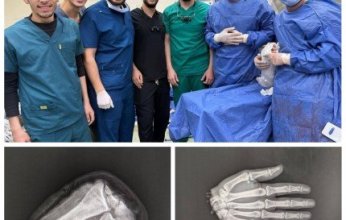 إنجاز طبي استثنائي.. أطباء مصريون يعيدون يدًا مبتورة لشاب في عملية استغرقت 12 ساعة