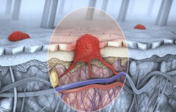 فيروس شائع يعزّز مناعة الجسم في مواجهة سرطان الجلد