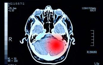 «لغز الطابق الخامس».. أورام دماغية غامضة تصيب موظفي مستشفى أمريكي وتثير القلق