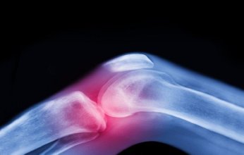 دواء "ميتفورمين" الشائع للسكري يخفف آلام التهاب مفاصل الركبة