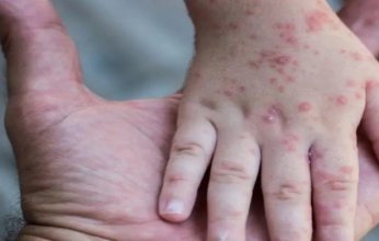 "الصحة السويسرية": تسجيل أول حالة إصابة بالمتحور الجديد من جدري القرود