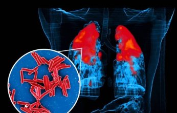 اكتشاف علمي من بريطانيا يفتح آفاقًا جديدة لمكافحة السل