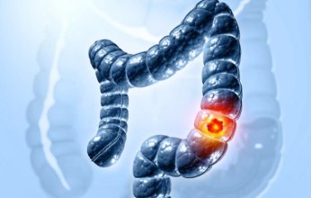 دراسة تحذر: تعاطي الحشيش يرفع خطر الوفاة بسرطان القولون بنسبة صادمة