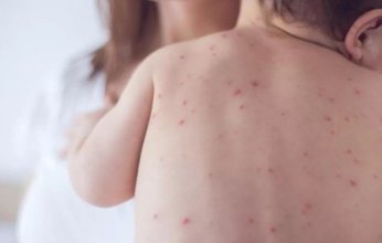 تفشي الحصبة يضرب تكساس الأمريكية ويهدد الملايين وسط تراجع في معدلات التطعيم