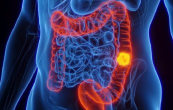 ما هي الأسباب الرئيسية للأورام القاتلة؟ وماذا عن سبل الوقاية منها؟