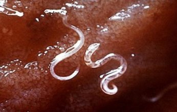 أعراض الإصابة بالديدان في الجسم.. .تحذيرات خاصة للأطفال