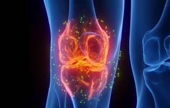 دراسة موسعة تكشف أبرز أسباب التهاب مفصل الركبة التنكسي وتحذر من العوامل المهنية ونمط الحياة