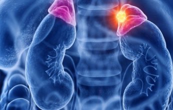 الجلد "الرخامي" قد يكون مؤشراً على ورم في الغدة الكظرية