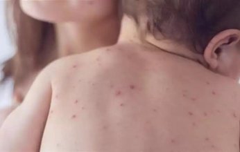 الحصبة تعود بقوة إلى الولايات المتحدة: أكثر من ألف إصابة مؤكدة و3 وفيات.. ماذا يحدث؟