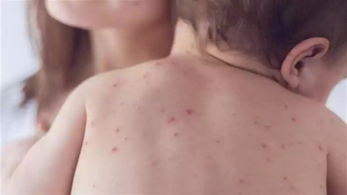الحصبة تعود بقوة إلى الولايات المتحدة: أكثر من ألف إصابة مؤكدة و3 وفيات.. ماذا يحدث؟ الحصبة تعود بقوة إلى الولايات المتحدة: أكثر من ألف إصابة مؤكدة و3 وفيات.. ماذا يحدث؟