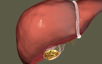 تعرف على الأسباب الرئيسية لتكوّن حصوات المرارة وطرق الوقاية