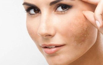 مع ارتفاع درجات الحرارة.. كيف تحمي نفسك من البقع الشمسية؟