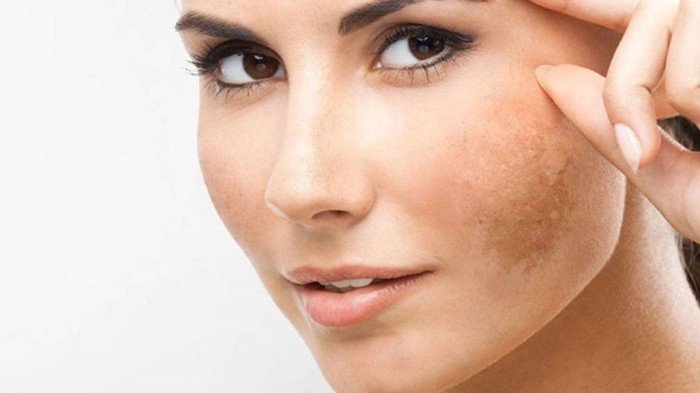 مع ارتفاع درجات الحرارة.. كيف تحمي نفسك من البقع الشمسية؟ مع ارتفاع درجات الحرارة.. كيف تحمي نفسك من البقع الشمسية؟