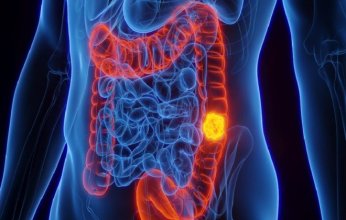 دراسة عالمية: الرياضة قد تُحدث تحولاً في علاج سرطان القولون وتزيد فرص النجاة