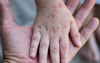 "الصحة العالمية": تفشي جدرى القرود في 49 دولة بإجمالي 6823 إصابة و16 وفاة