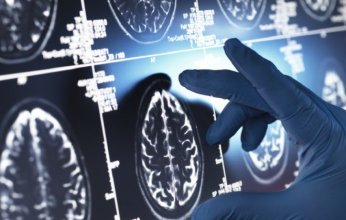 اختبار دم بسيط قد يساعد في التنبؤ بسرعة تطور مرض ألزهايمر