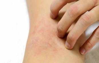 فريق بحثي أمريكي يتوصل لعلاج يحسن حالة مرضى سرطان الجلد المتقدم