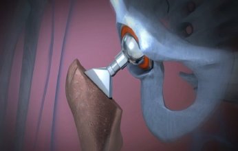 ابتكار علمي يحول البول إلى مادة تستخدم في زراعة العظام والأسنان