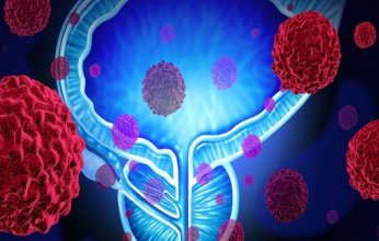 دراسة بريطانية: اختبار ذكاء اصطناعي جديد يمنح أملا جديدا لمرضى سرطان البروستاتا